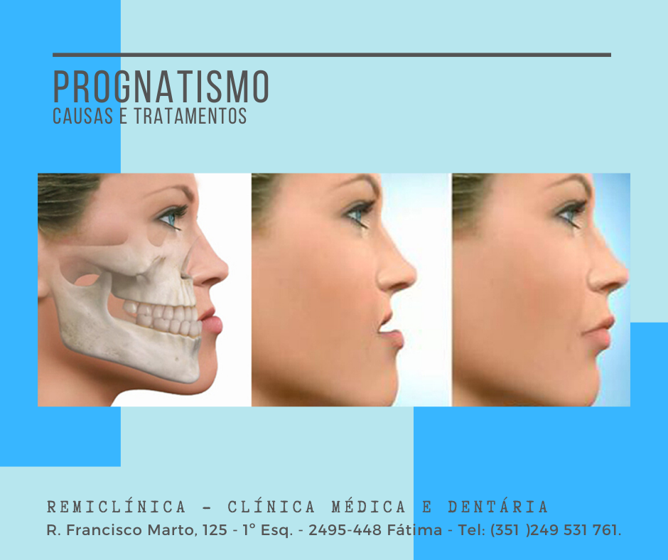 Prognatismo mandibular – Wikipédia, a enciclopédia livre